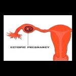 About the signs of ectopic pregnancy