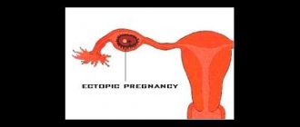 О признаках внематочной беременности