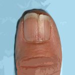 Onychorrhexis or crack along the nail