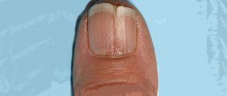 Onychorrhexis or crack along the nail