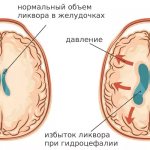 Features and mechanism of development of hydrocephalus