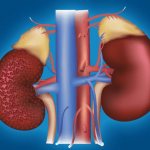 Acute renal failure - sudden cessation of kidney function