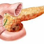 Acute pancreatitis is a life-threatening disease