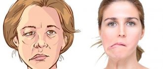 Bell&#39;s palsy