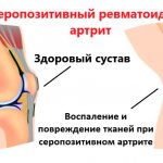 Патогенез серопозитивного артрита
