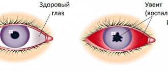 Anterior and posterior uveitis of the eye