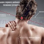 Subluxation of the atlas (dorsal view)