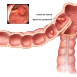 rectal polyps types, classification, treatment, rectal polyp in an adult