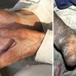 consequences of leprosy photo