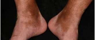 Посттравматический гемосидероз на ногах