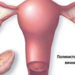 Causes of premature ovarian failure syndrome
