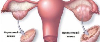 Причины синдрома преждевременного истощения яичников