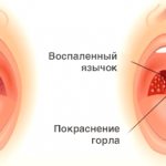 signs of sore throat