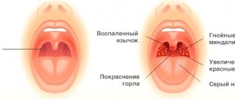 signs of sore throat