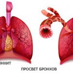 signs of bronchitis