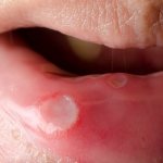 signs of stomatitis