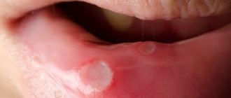 signs of stomatitis