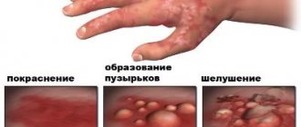 Manifestation of eczema