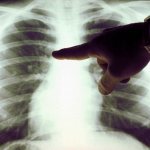 Lung cancer: symptoms and signs