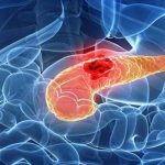 Pancreatic cancer: symptoms and treatment