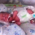 Child with mechanical ventilation