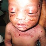 ребенок с врожденным сифилисом