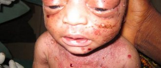 ребенок с врожденным сифилисом