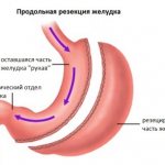 Gastric resection