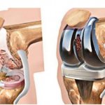 Рис. 5. Тотальное эндопротезирование коленного сустава состоит из трех компонентов: бедренного, большеберцового и надколенникового