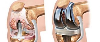 Рис. 5. Тотальное эндопротезирование коленного сустава состоит из трех компонентов: бедренного, большеберцового и надколенникового