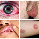 Symptoms of Behçet&#39;s disease