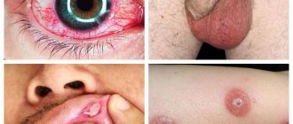 Symptoms of Behçet&#39;s disease