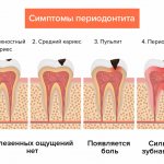Symptoms of periodontitis in pictures: from the asymptomatic stage to severe pain.