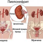Symptoms of pyelonephritis in men and women
