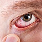 Remedies for the treatment of allergies on the eyes and eyelids