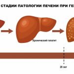 Stages of liver disease.jpg