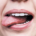 Stomatitis on the tongue - Dentistry &quot;Line of Smile&quot;