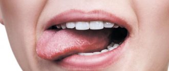 Стоматит на языке - Стоматология «Линия Улыбки»
