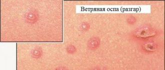 Chickenpox rash