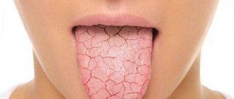 cracks in the tongue