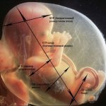 Трисомия 21.18.13: норма в 1 триместре у беременных