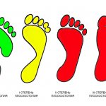 Types and stages of flat feet