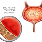 inflammation of the bladder - cystitis