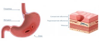Воспаленная язва и схема поперечного сечения слизистой оболочки желудка