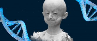 A young Ukrainian woman died due to premature aging. There is no cure for progeria, but many manage to live brightly 