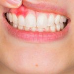 Dental abscess or abscess - what kind of beast?